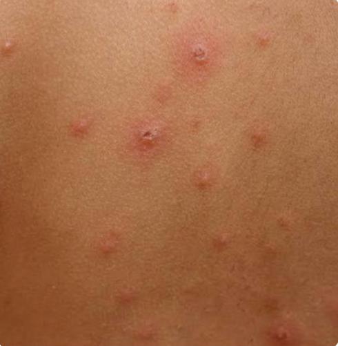 Chicken Pox