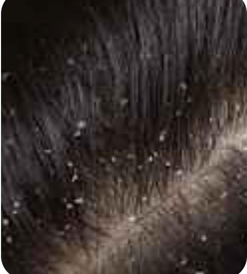 Dandruff