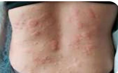 Measles and/or Skin Rash