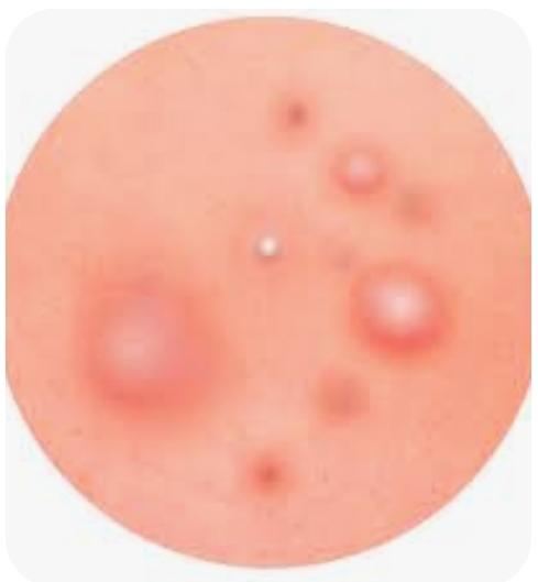 Skin Eruption and Dermatitis