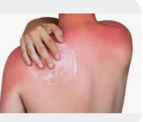 Sunburn