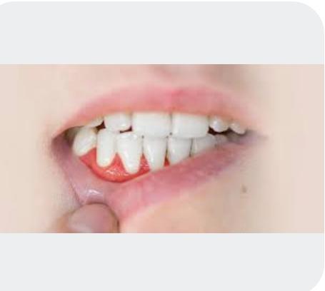 Swollen gum and mouth inflammation